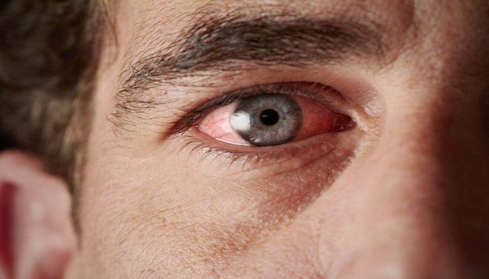 Göz zədələnməsinə səbəb olan allergik xəstəliklərin səbəbi açıqlandı