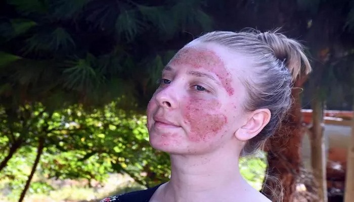 Cilt bakımı yaptırırken yüzünde yanıklar oluşan Müge, 6 ay tedavi görecek