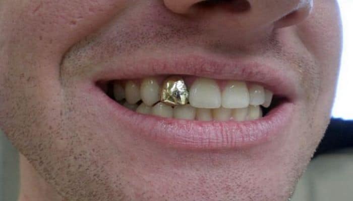 2020-ci ildə qızıl dişlər dəbdə olacaq