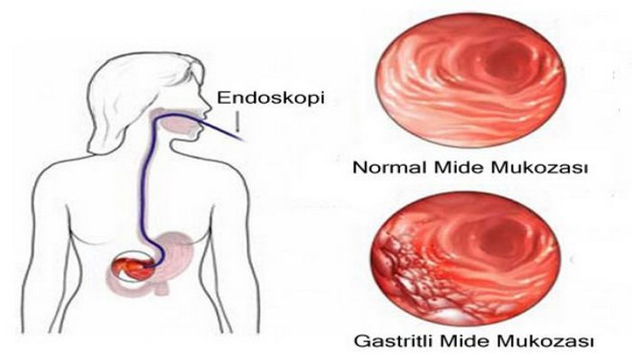 Gastrit