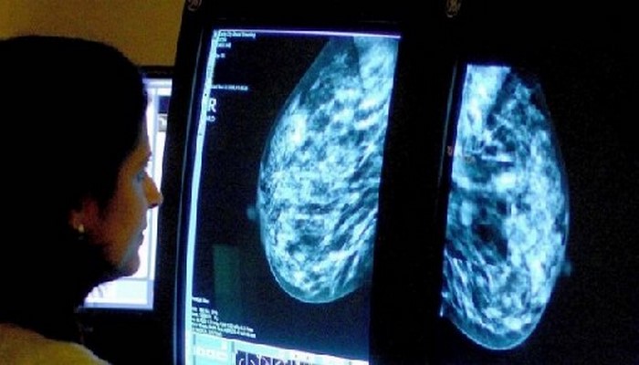 Обследование груди среди женщин в возрасте 40-49 лет спасает до 400 жизней ежегодно - исследование